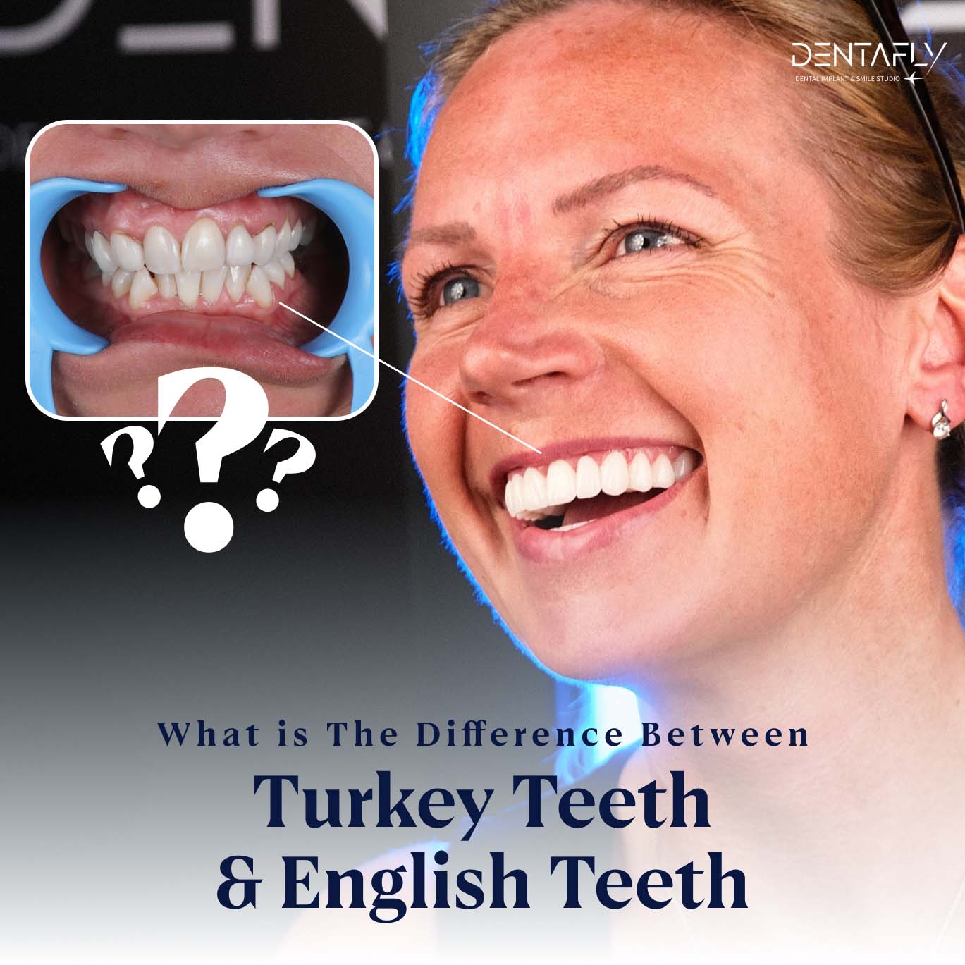 Difference Between Turkey Teeth and English Teeth