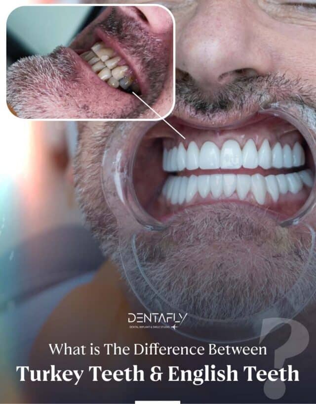 Difference Between Turkey Teeth and English Teeth