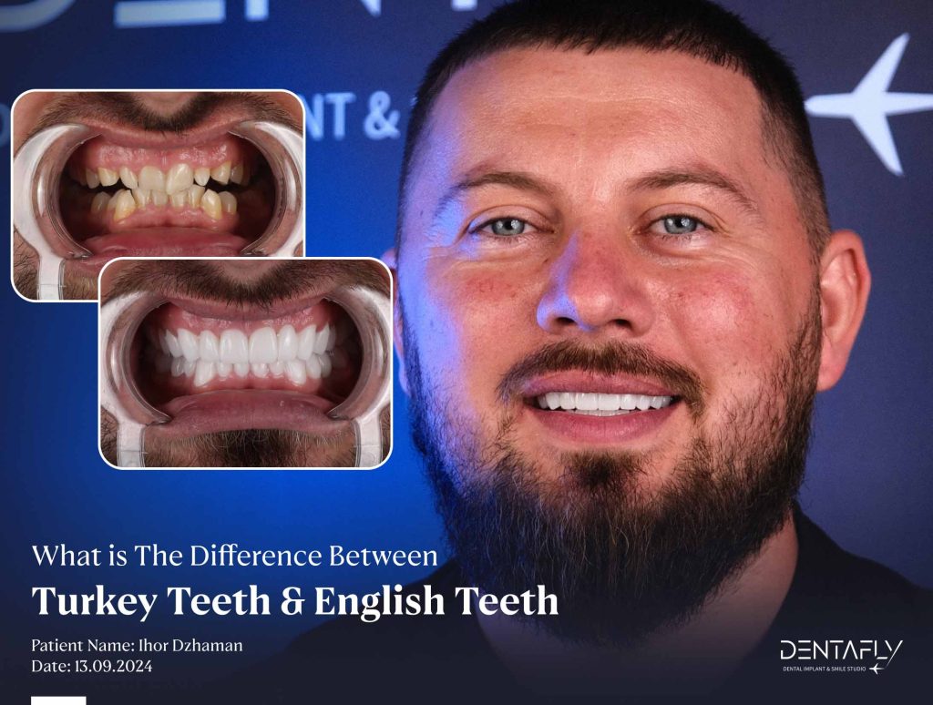 What is the difference between Turkey Teeth and English Teeth?