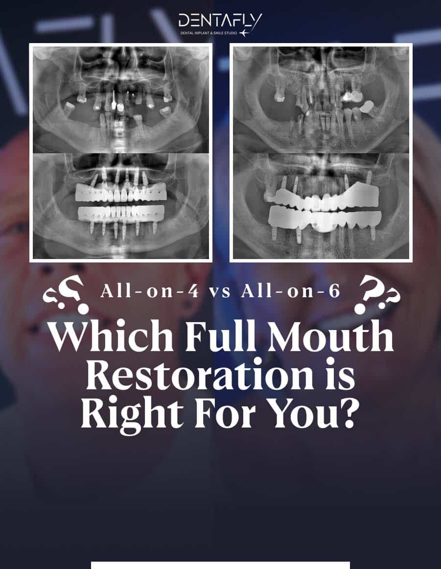 Comparing All-on-4 and All-on-6