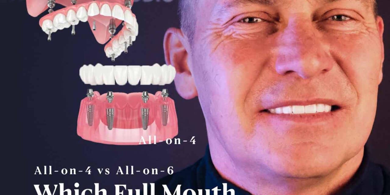 All-on-4 vs. All-on-6: Which Full-Mouth Restoration Is Right for You?