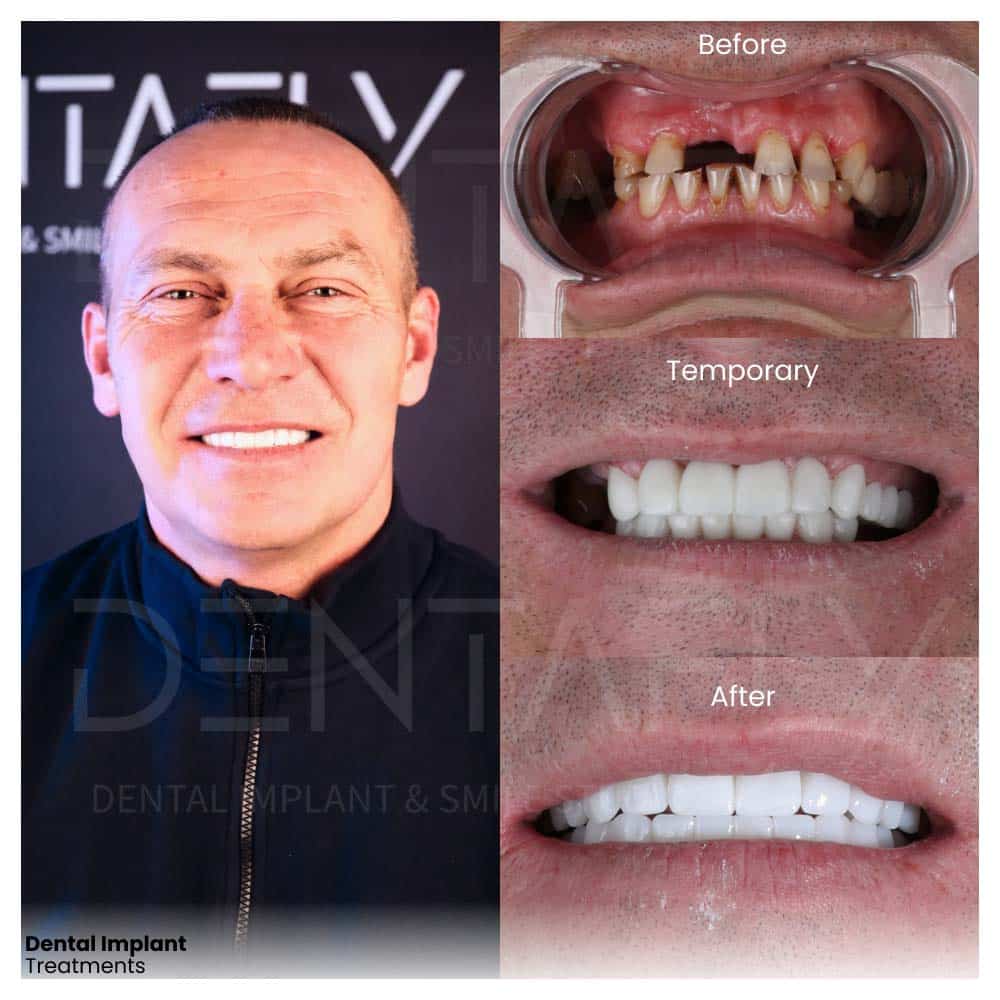 dental-implant-treatments-before-after-1