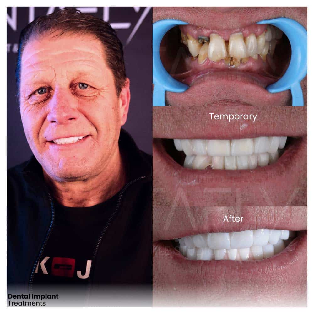 dental-implant-treatments-before-after-2