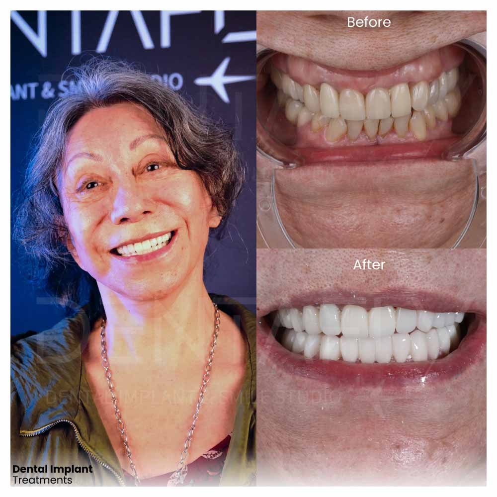 dental implant treatments before after