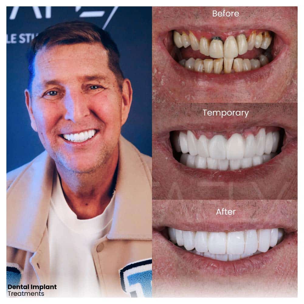 dental implant process before and after