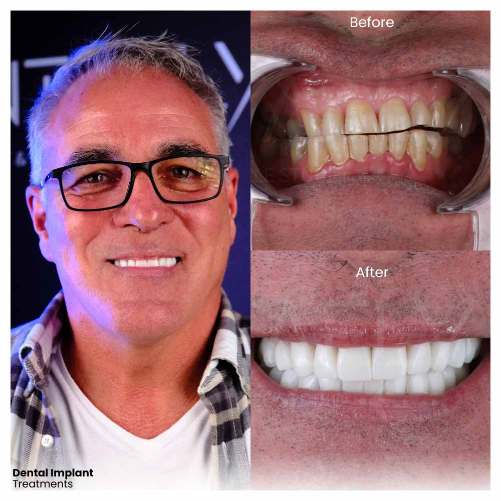 dental implant before and after process