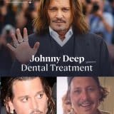 Johnny Depp dental transformation