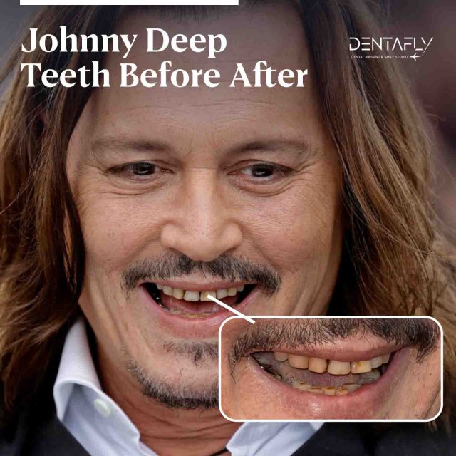 Johnny Depp Teeth Before and After
