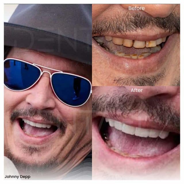 Johnny Depp Teeth Before and After
