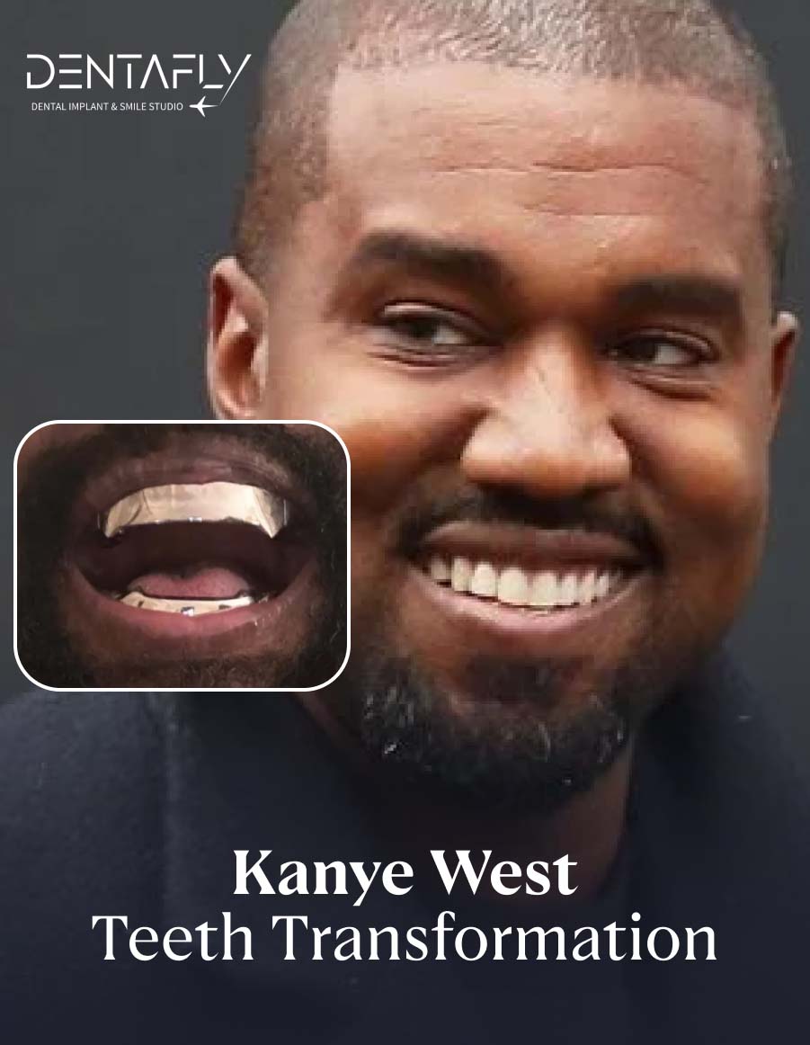 Kanye West's Teeth Transformation Kanye West's Teeth Transformation