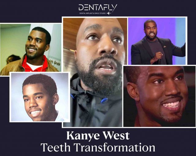 Kanye West's teeth timeline
