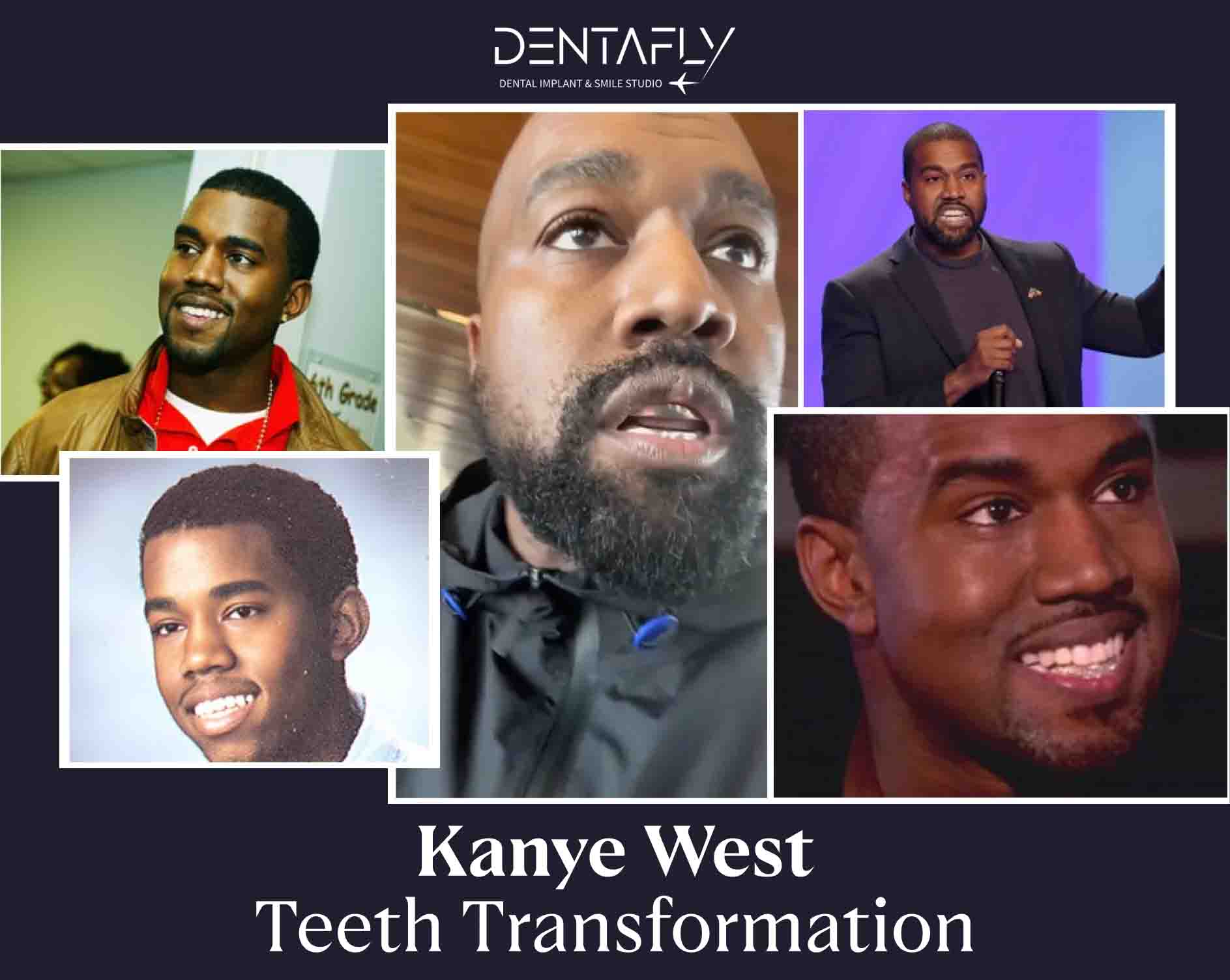 Kanye West’s Teeth: Complete Guide, Costs, Before & After Transformation