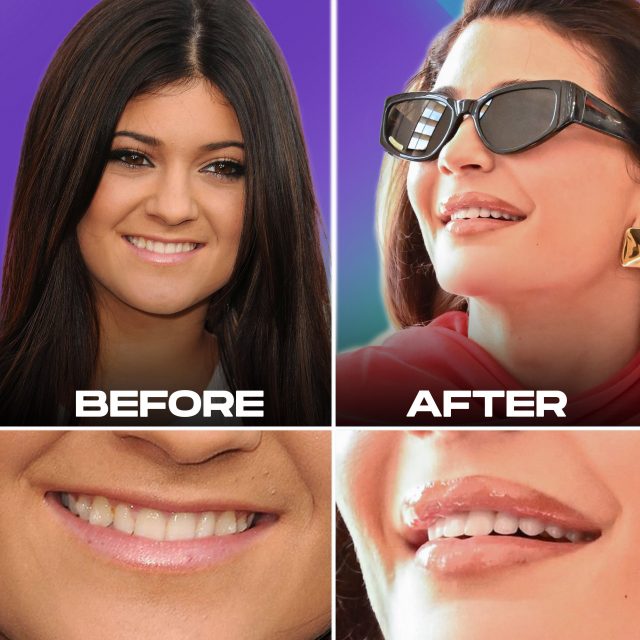 Kylie Jenner Teeth Before and After View