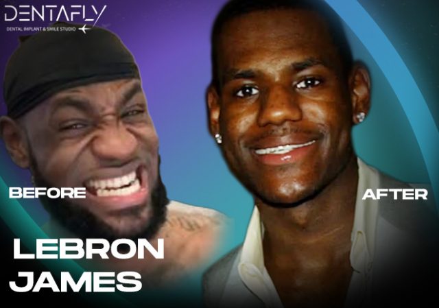LeBron James teeth before and after