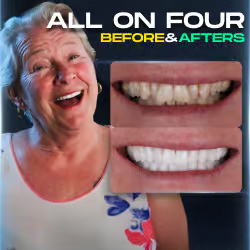 All-on-4 before and after gallery thumbnail
