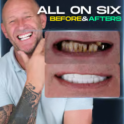 All-on-6 dental implants in Turkey gallery