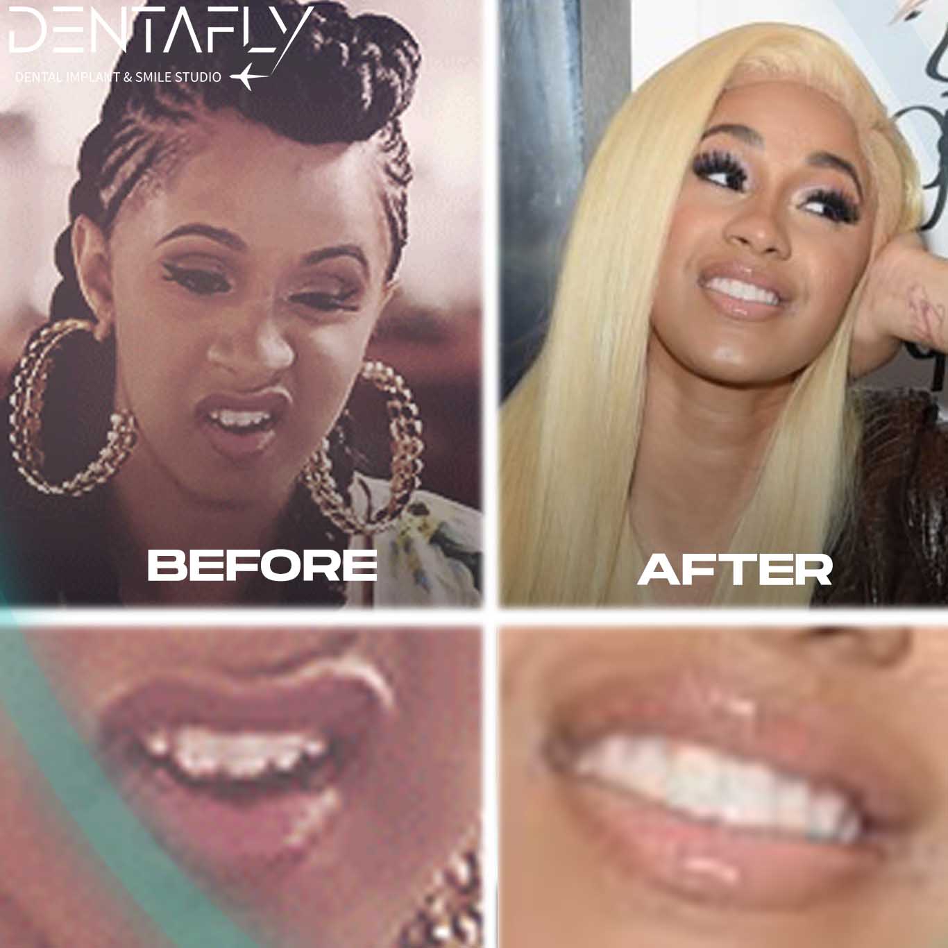 Cardi B's teeth before fame