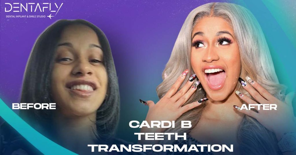 Cardi B Teeth Transformation: Before, After & Procedure Explained