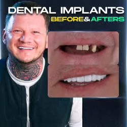 Dental Implants before and after gallery thumbnails