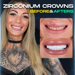 thumbnail photo of zirconia crowns