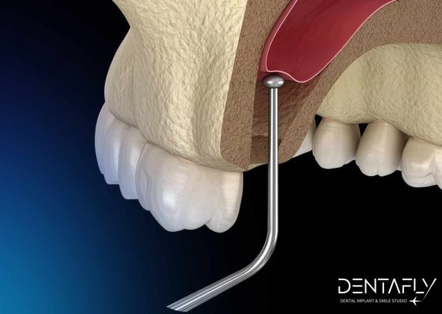 Bone graft material being inserted into the sinus cavity during an internal sinus lift surgery to increase bone height for dental implants.