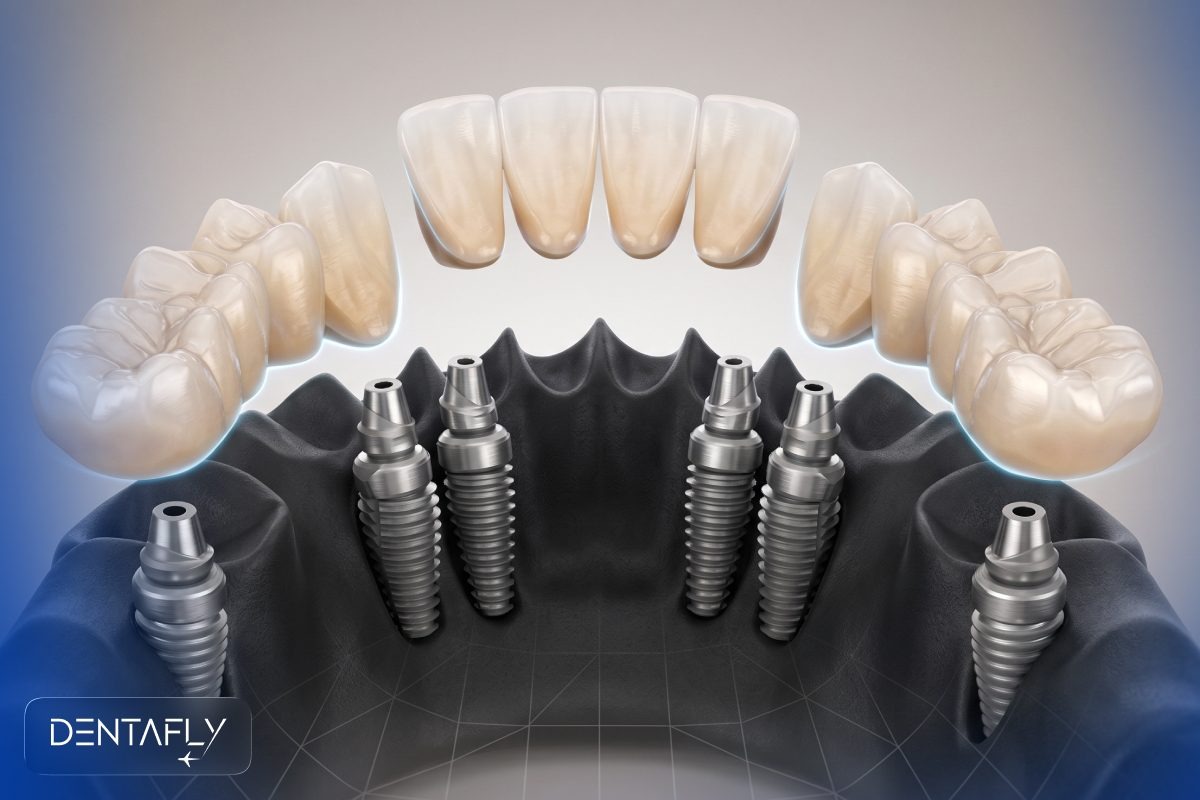 3-on-6 dental implants treatment at Dentafly Antalya clinic with premium Straumann Nobel Biocare implants zirconia bridges
