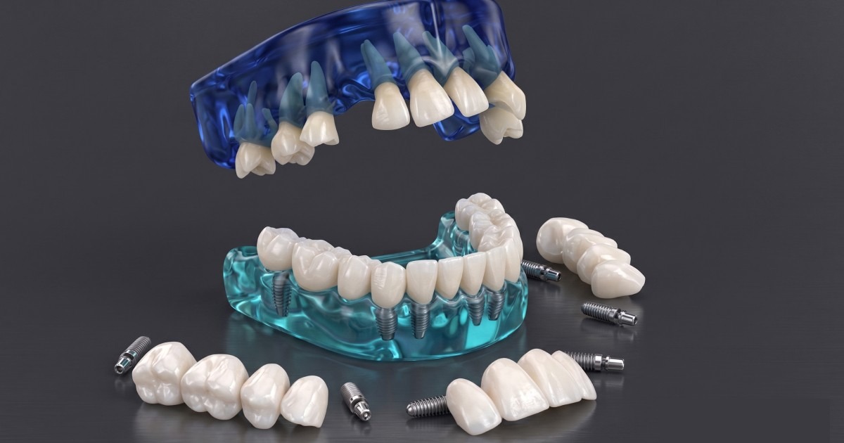 3-on-6 dental implants Turkey three porcelain bridges supported by six titanium implants per arch AACI accredited Dentafly Antalya UK aftercare