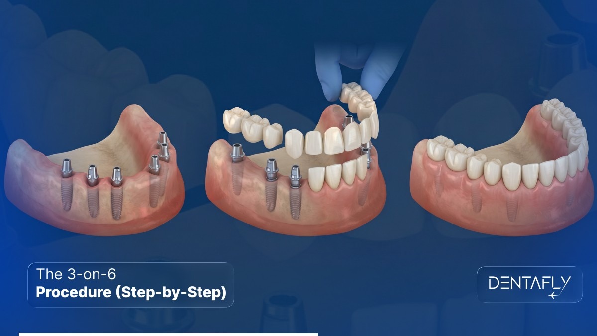 3-on-6 procedure step by step from implant placement to final zirconia bridge fitting CAD CAM digital workflow Antalya