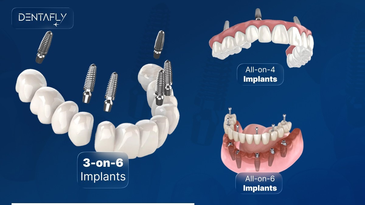 3-on-6 vs All-on-4 vs All-on-6 dental implants comparison chart showing differences in bridges bone requirements hygiene cost