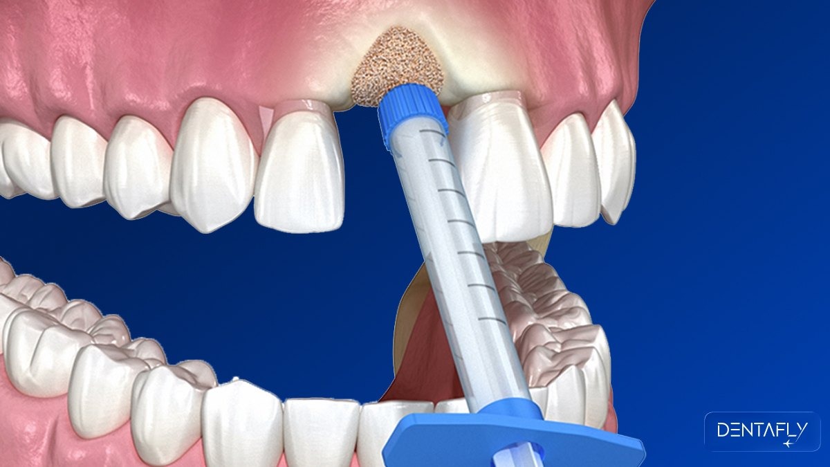 3D illustration of bone graft material being injected into anterior maxilla for dental implant preparation