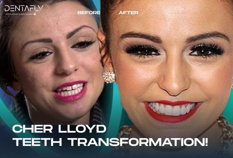 Cher Lloyd smile transformation