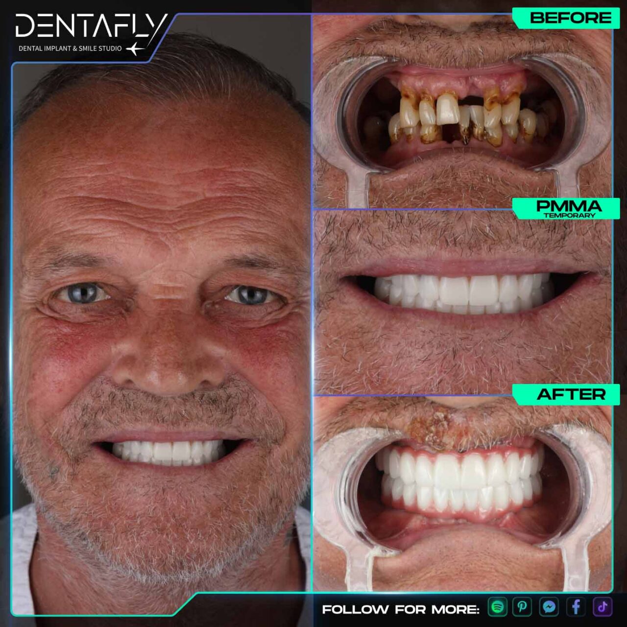 Cliff dental implant before and after