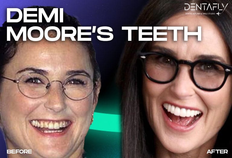 Demi Moore smile before and after