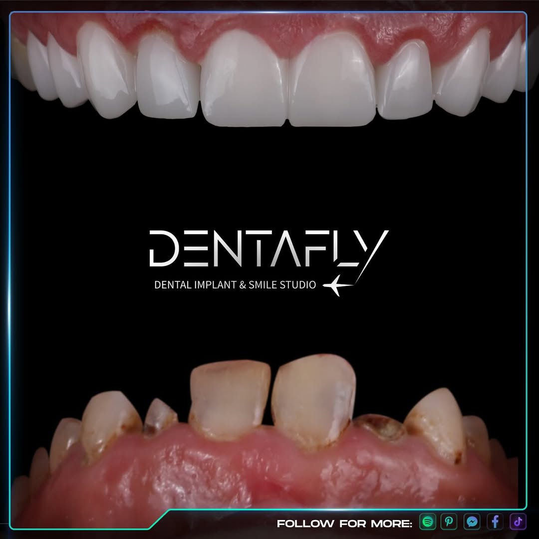 Dental bonding treatment