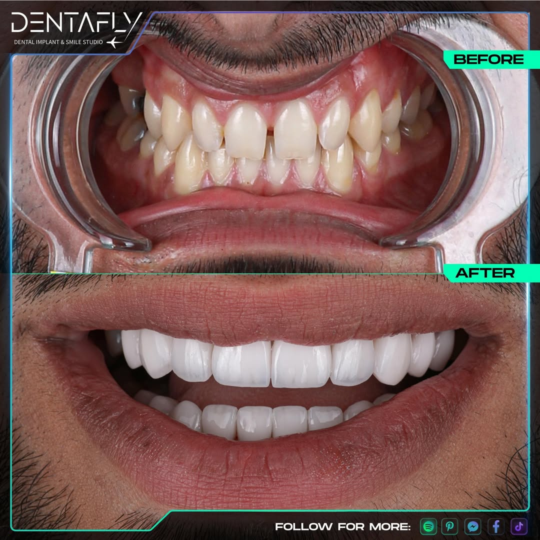 Dental bonding with cosmetic dentistry