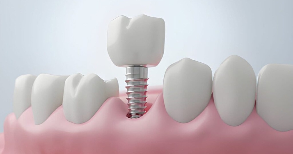3D dental implant illustration showing premium quality available at UK and Turkey clinics