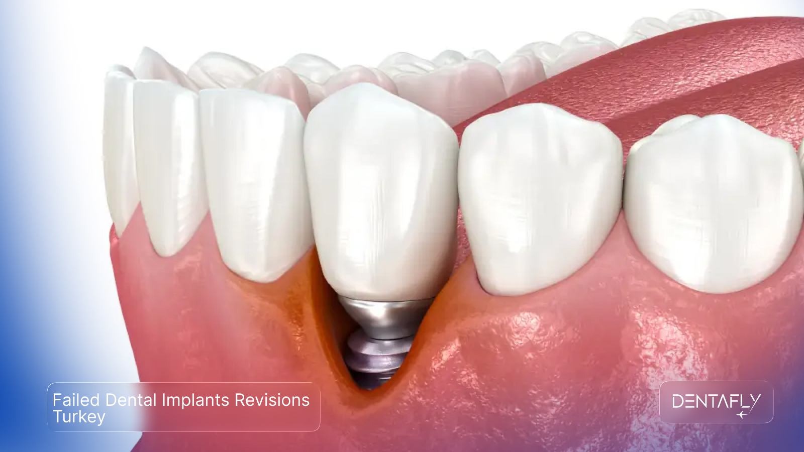 Failed dental implants revision Turkey peri-implantitis treatment osseointegration failure rescue surgery AACI accredited Dentafly Antalya
