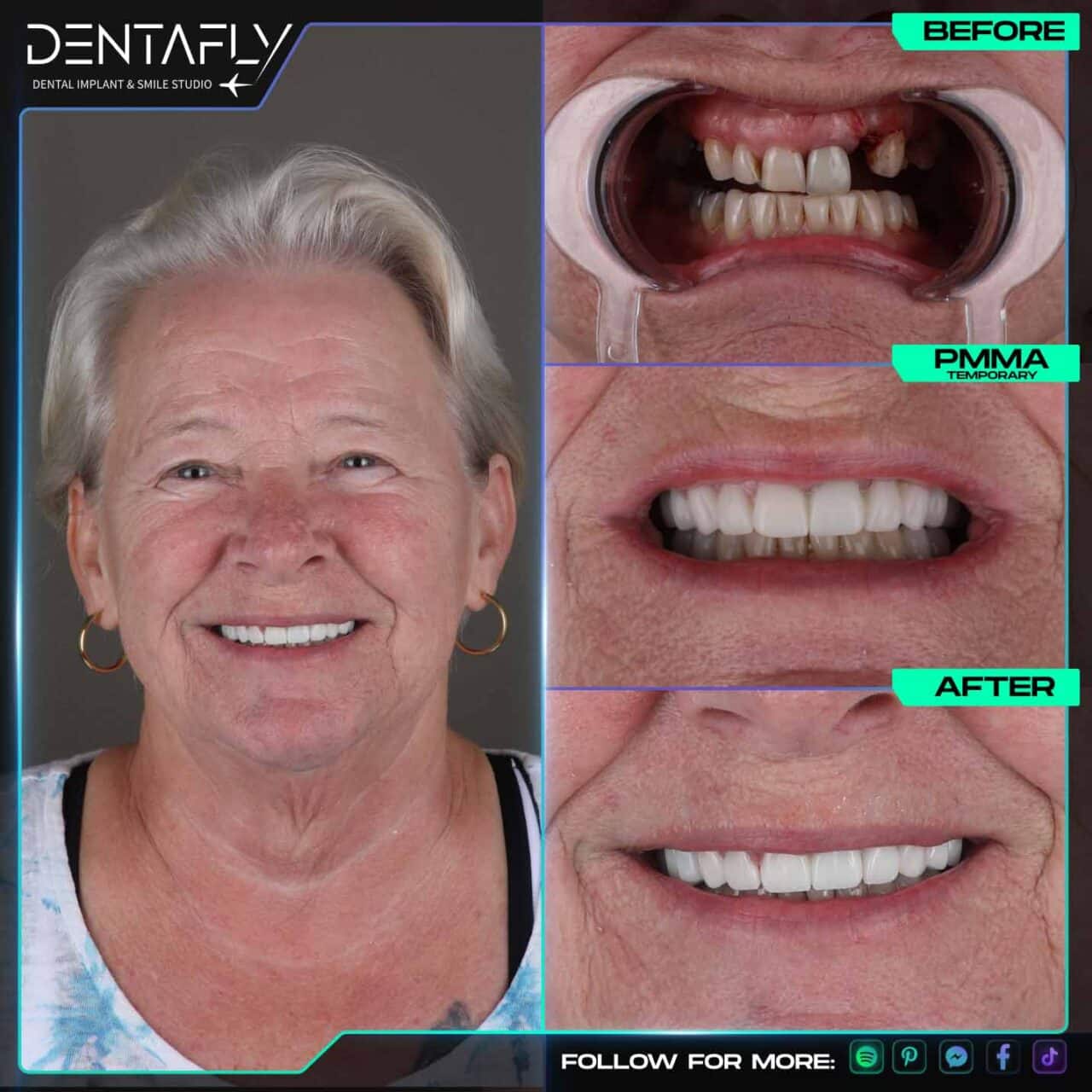 Georgina Butt dental implant before and after