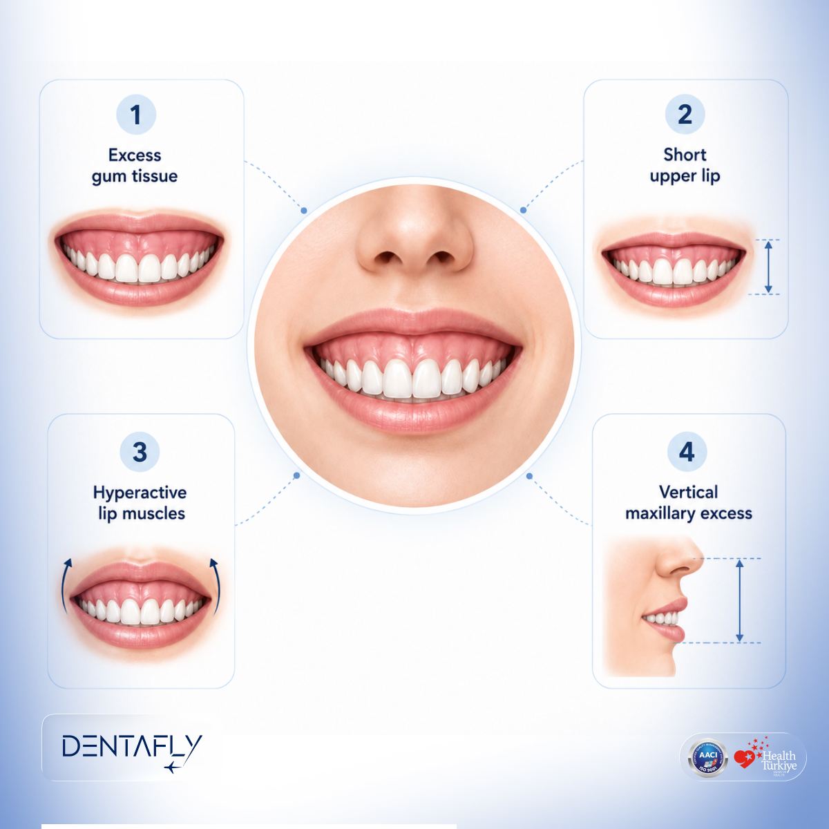 Excessive gingival display causes anatomical illustration excess gum tissue short upper lip hyperactive lip muscles vertical maxillary excess Dentafly periodontology