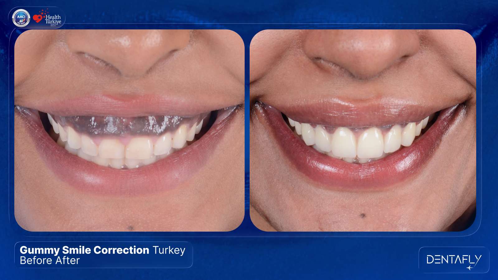 Gummy smile correction Turkey before after UK patient excessive gingival display laser treatment Dentafly Antalya periodontology