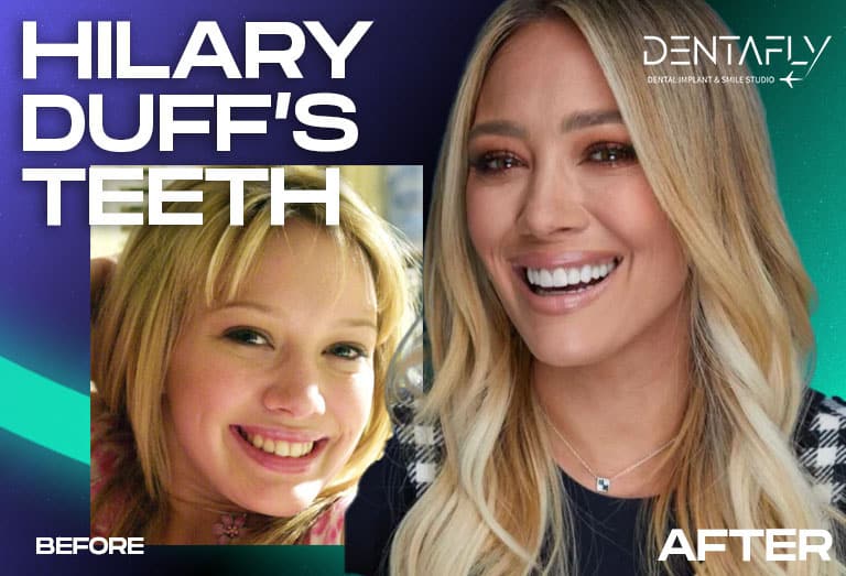Hilary Duff smile before and after