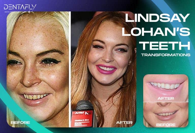 Lindsay Lohan smile transformation