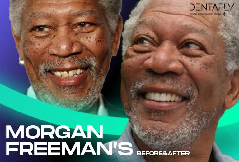 Morgan Freeman smile before and after