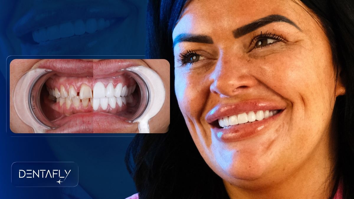 Nervous patient success story UK before after dental avoidance to confident smile IV sedation all-on-4