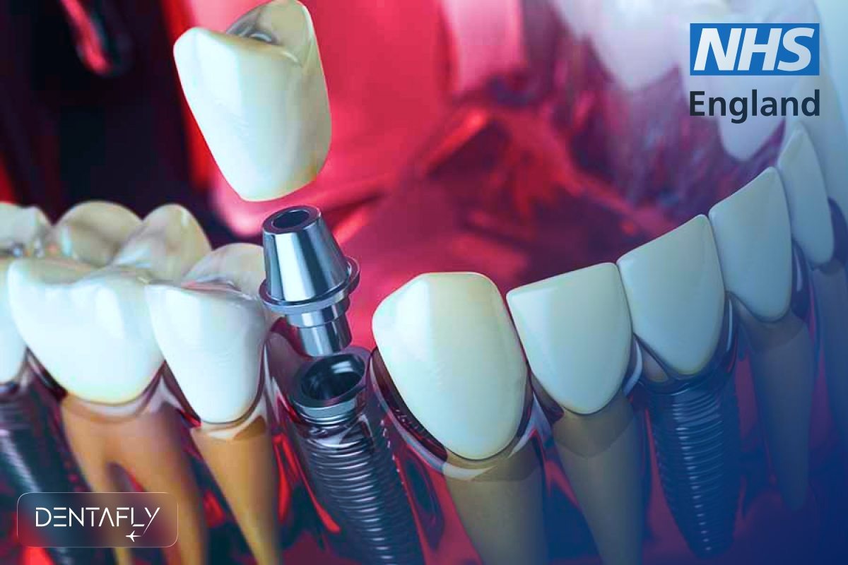 NHS dental implant alternative for UK patients with Dentafly Turkey premium implants
