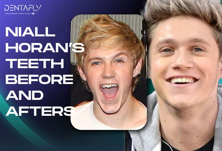 Niall Horan smile before and after
