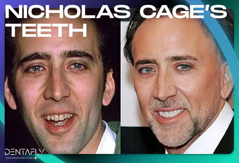 Nicholas Cage smile transformation