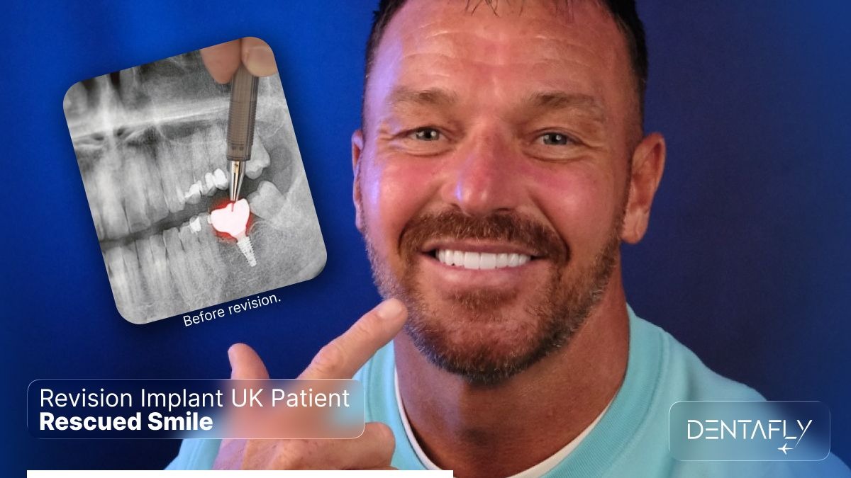 Revision implant UK patient rescued smile before after success Dentafly Antalya