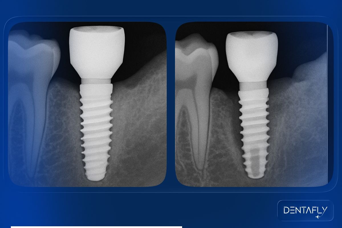 Revision vs original implant comparison table showing biological complexity tissue conditions surgical technique differences