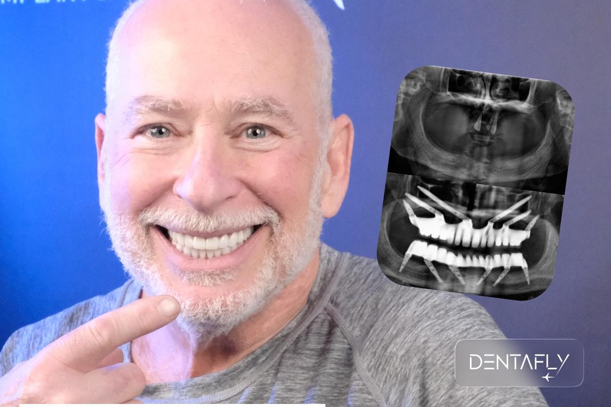 Same day teeth with zygomatic implants immediate loading temporary bridge protocol